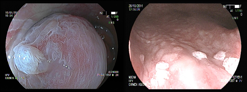 Endoscopía